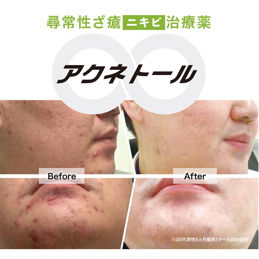 アクネトール