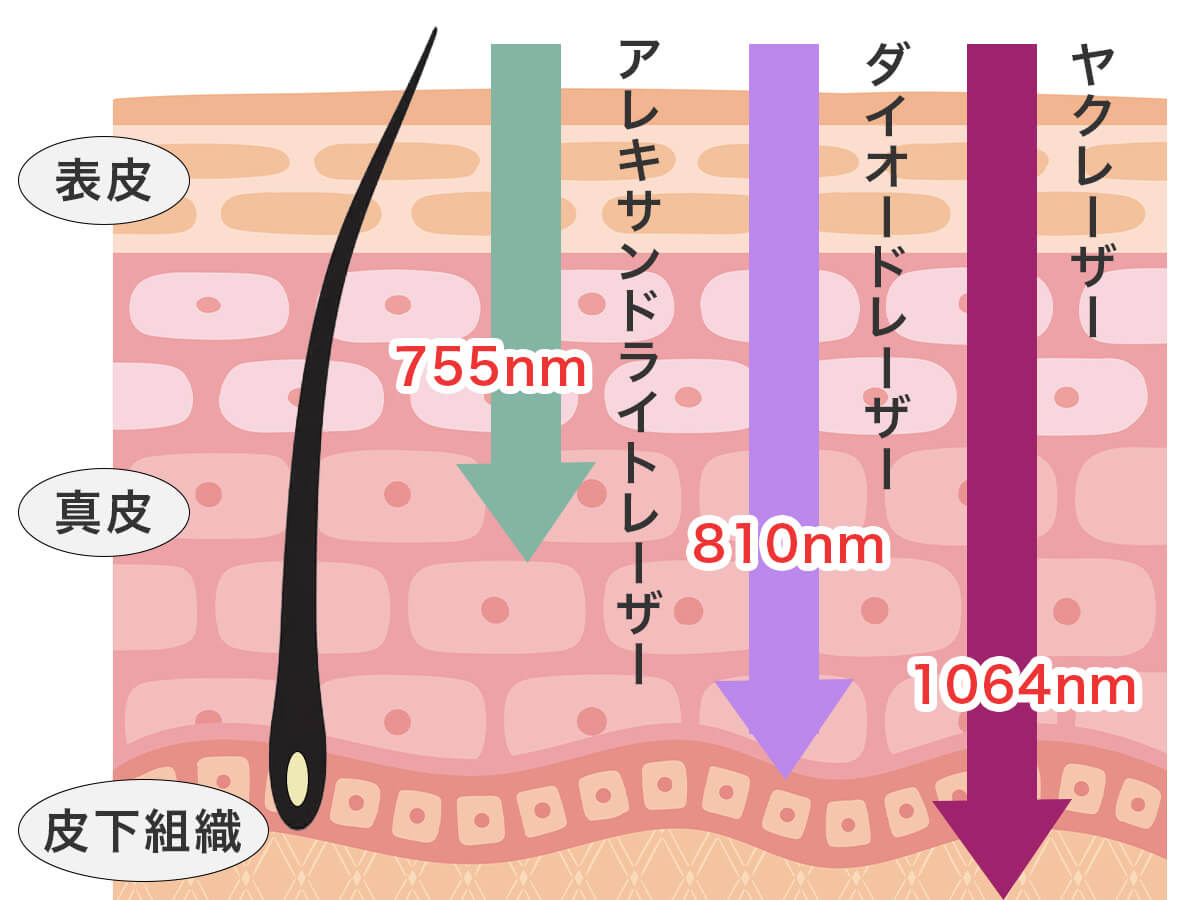 医療レーザー脱毛