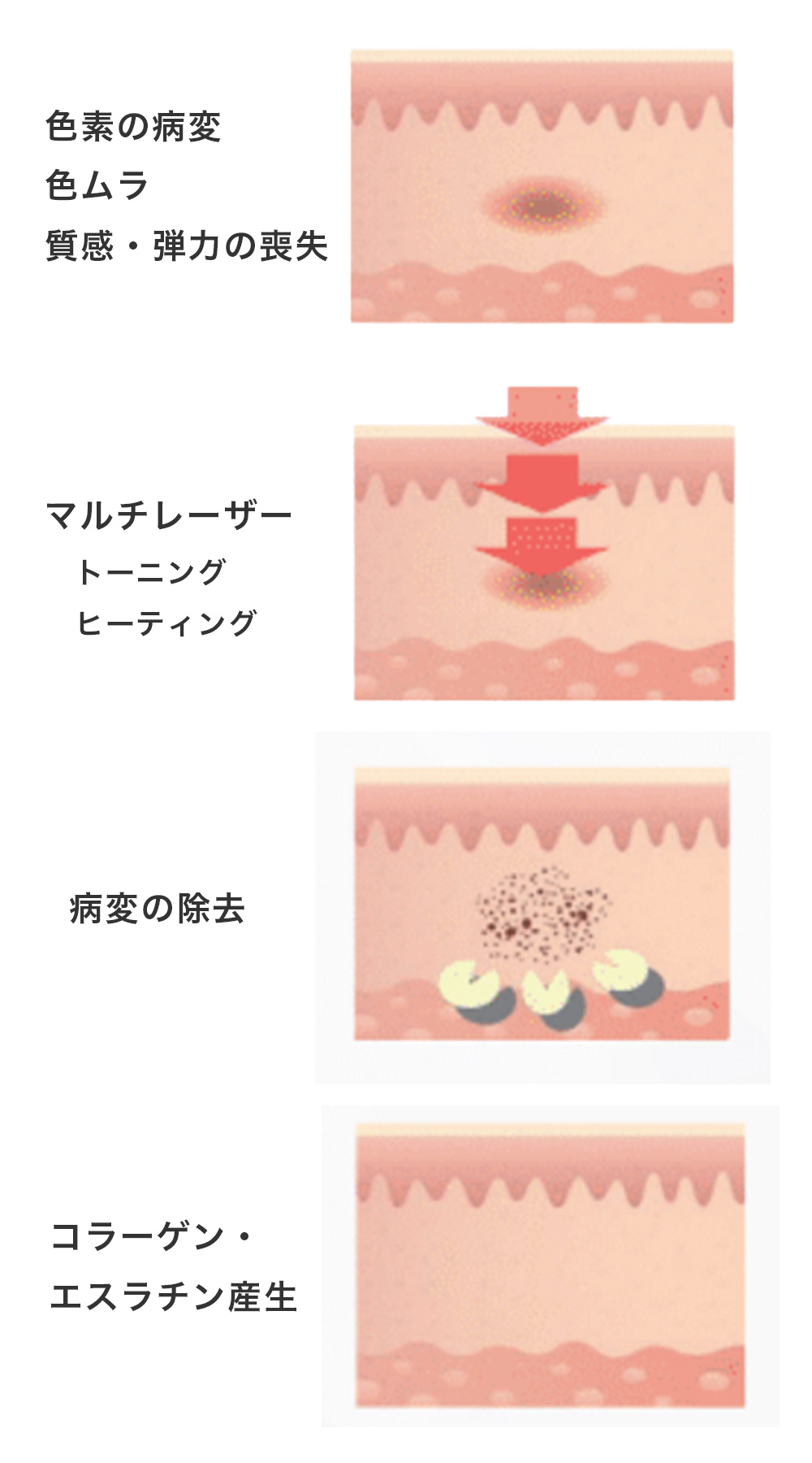 レーザートーニング
