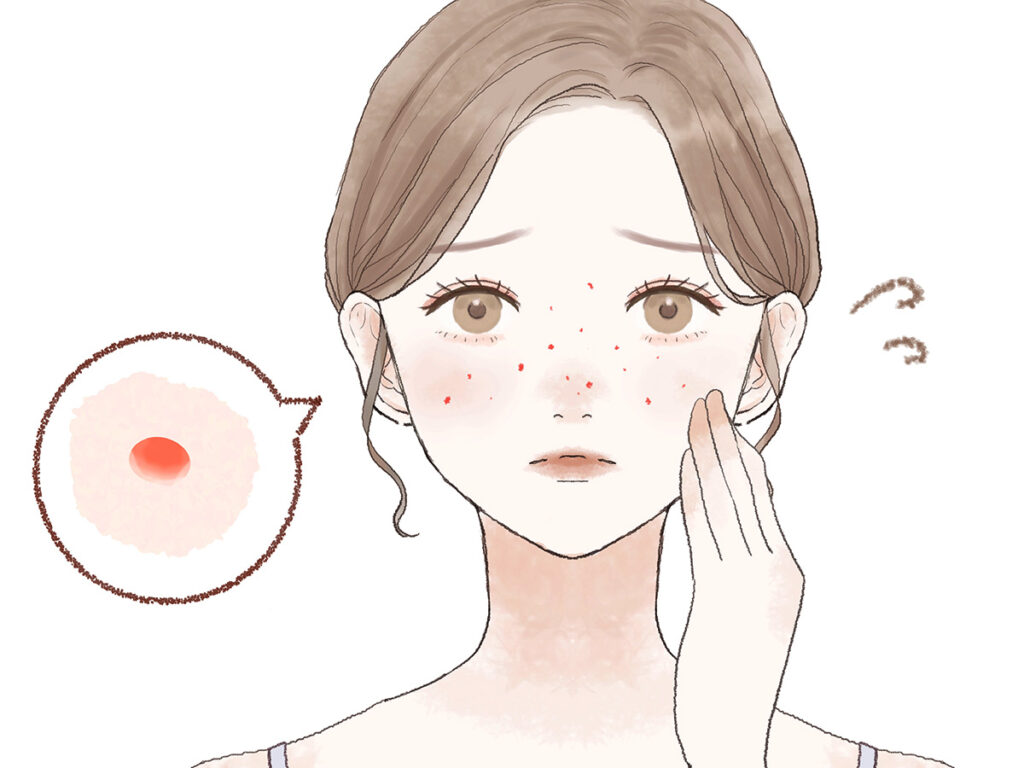 ニキビ、肌割れ